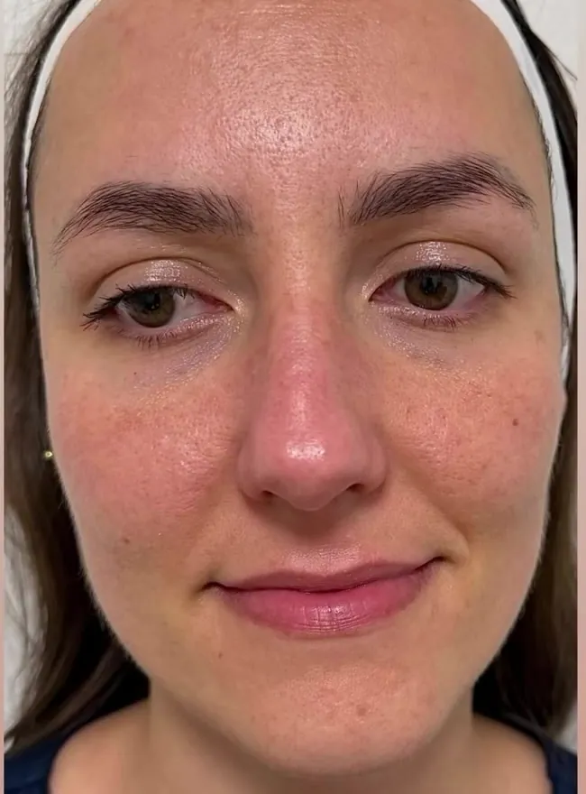 Before: skin with texture and redness