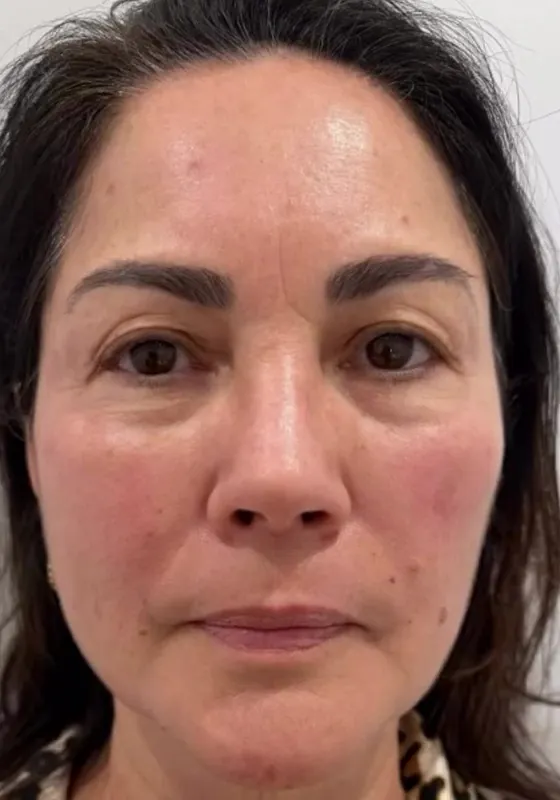 After — Spots, texture and fine lines