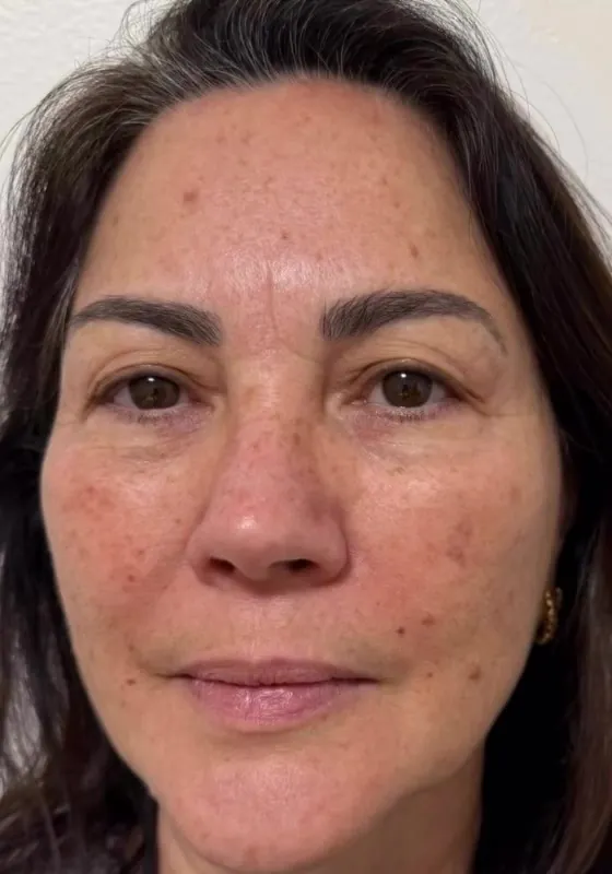 Before — Spots, texture and fine lines