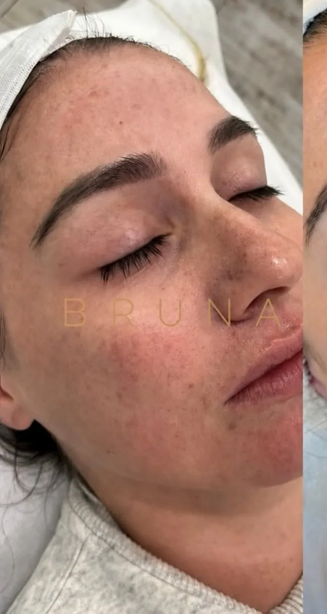 Before — Clearer, brighter skin