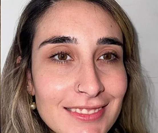 After — Melasma, spots and freckles