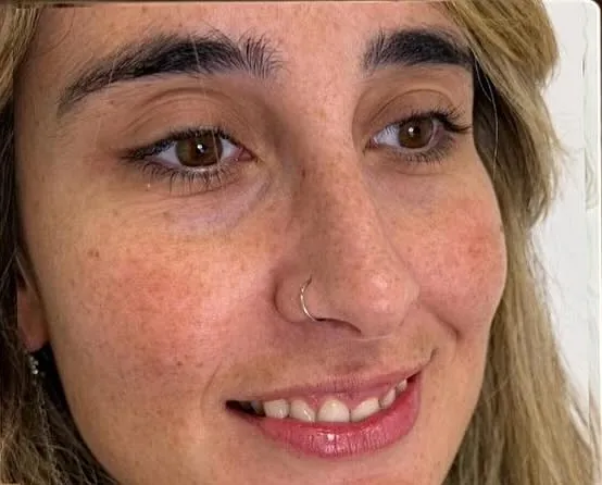 Before — Melasma, spots and freckles
